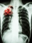 Mycobacterium Tuberculosis Infection (pulmonary Tuberculosis) Stock Photo