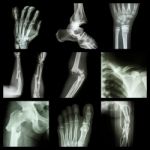 Collection Of Bone Fracture Stock Photo