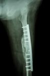 Fracture Shaft Of Femur. It Was Operated And Internal Fixation B Stock Photo