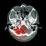 Brain Injury, Stroke : ( Ct Scan Of Brain And Base Of Skull ) ( Bone Window ) Stock Photo