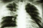 Lobar Pneumonia Stock Photo