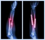 Fracture Both Bone Of Forearm. It Was Operated And Internal Fixed With Plate And Screw (left Image : Before Operation , Right Image : After Operation) Stock Photo