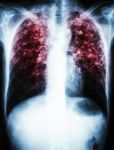 Mycobacterium Tuberculosis Infection (pulmonary Tuberculosis) Stock Photo