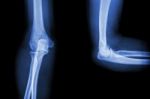 Film X-ray Elbow Ap(antero-posterior)/lateral Stock Photo