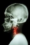 X-ray Asian Skull And Cervical Spine And Neck Pain Stock Photo