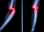 Supracondylar Humerus Fracture Stock Photo