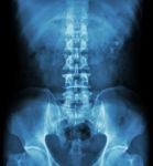 Kidney Stone ( Renal Stone , Renal Calculi ) ( Film X-ray Kub ( Kidney - Ureter - Bladder ) Show Left Renal Stone ) Stock Photo