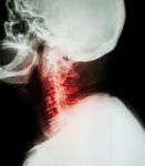 Cervical Spondylosis .  Film X-ray Of Cervical Spine ( Lateral Position ) ( Side View ) Stock Photo