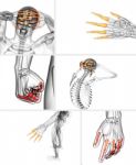 3d Rendering  Illustration Of The Human Phalanges Hand Stock Photo