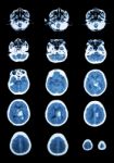 Hemorrhagic Stroke .  Ct Scan (computed Tomography) Of Brain ( C Stock Photo