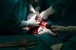 Cesarean Section Stock Photo