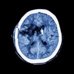 Ct Scan Of Brain : Show Old Right Basal Ganglia Hemorrhage With Brain Edema ( Status Post Craniotomy ) ( Hemorrhagic Stroke ) Stock Photo