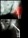 Intertrochanteric Fracture Left Femur (fracture Thigh's Bone). It Was Operated And Inserted Intramedullary Nail Stock Photo