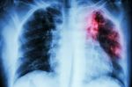 Pulmonary Tuberculosis .  Chest X-ray : Interstitial Infiltratio Stock Photo