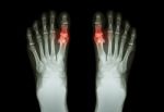 Gout , Rheumatoid Arthritis ( Film X-ray Both Foot And Arthritis At First Metatarsophalangeal Joint ) ( Medicine And Science Background ) Stock Photo