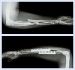 Upper Image : Fracture Ulnar And Radius (forearm Bone) , Lower Image : It Was Operated And Internal Fixed With Plate And Screw Stock Photo