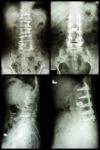 "spondylosis And Spondylolisthesis"  It Was Operated And Internal Fixed At Spine (left Image : Before Operated) (right Image : After Operated) Stock Photo