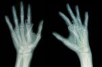 Film X-ray Of Hand Fracture  Insert K-wire Stock Photo