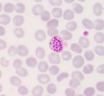 Blood Films For Malaria Parasite Stock Photo