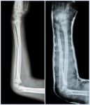 Fracture Shaft Of Ulnar Bone ( Forearm Bone )  : ( Left : Pre-treatment  ,  Right : Psot-treatment (splint With Cast) ) Stock Photo