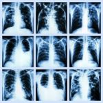 Collection Of Lung Disease (pulmonary Tuberculosis,pleural Effusion,bronchiectasis) Stock Photo