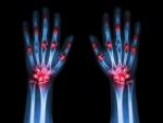 Multiple Joint Arthritis Both Hands ( Gout , Rheumatoid ) On Black Background Stock Photo