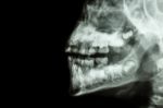 Human's Jaw And Teeth Stock Photo