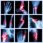 Collection Of Bone Fracture Stock Photo