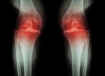 Osteoarthritis Knee ( Oa Knee ) ( Film X-ray Both Knee With Arthritis Of Knee Joint : Narrow Knee Joint Space ) ( Medical And Science Background ) Stock Photo