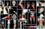 Collection X-ray Multiple Human's Organ & Orthopedic Surgery & Multiple Disease (pulmonary Tuberculosis , Gout , Rheumatoid Arthritis ,spondylosis , Fracture Bone , Stroke , Brain Tumor , Etc) Stock Photo