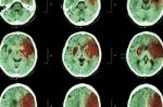 Ischemic Stroke : ( Ct Of Brain Show Cerebral Infarction At Left Frontal - Temporal - Parietal Lobe ) ( Nervous System Background ) Stock Photo