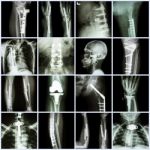 Collection X-ray Orthopedic Surgery (multiple Part Of Human, Operate And Internal Fixation By Plate&screw ) Stock Photo