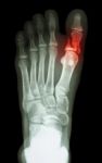 Fracture Proximal Phalange At First Toe Stock Photo