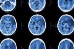 Ischemic Stroke : ( Ct Of Brain Show Cerebral Infarction At Left Frontal - Temporal - Parietal Lobe ) ( Nervous System Background ) Stock Photo