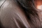 Women Having Dandruff In The Hair And Shoulder Stock Photo