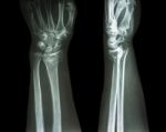 Fracture Distal Radius (colles' Fracture) (wrist Broken) Stock Photo