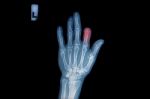 X-ray Of Trauma Hand And Loss Finger Stock Photo