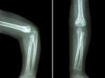 Film X-ray Of Child 's Elbow ( Normal Child 's Elbow ) ( Side And Front View , Lateral And Anterior - Posterior View ) ( 2 Position ) Stock Photo