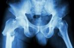 Fracture Right Femur (thigh's Bone) Stock Photo