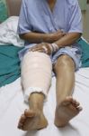 Knee Replacement Incision Stock Photo