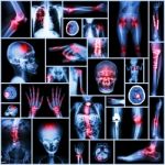 Collection X-ray Part Of Human,orthopedic Operation,multiple Disease (fracture,gout,rheumatoid Arthritis,osteoarthritis Knee,stroke,brain Tumor,scoliosis,tuberculosis, Etc.) Stock Photo