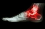 X-ray Human's Ankle With Arthritis Stock Photo