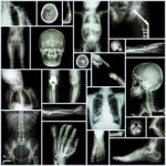 Collection X-ray "multiple Part Of Human" ,"orthopedic Surgery" And "multiple Disease" (fracture,shoulder Dislocation,osteoarthritis Knee,bronchiectasis,lung Disease,stroke,brain Tumor, Etc) Stock Photo