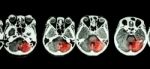 Stroke  ( Ct Scan Of Brain And Base Of Skull And Stroke ) Stock Photo