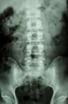 Normal Human Lumbar-sacrum Spine Stock Photo