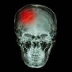 X-ray Asian Skull (thai People) And Headache Stock Photo