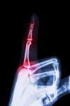 Rheumatoid Arthritis , Gouty Arthritis ( Film X-ray Index Finger And Hand ( Point A Finger ) And Inflame At Finger ) Stock Photo