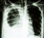 Pleural Effusion Due To Lung Cancer Stock Photo