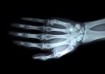 X-ray Right Hand Stock Photo