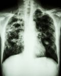 Mycobacterium Tuberculosis Infection (pulmonary Tuberculosis) Stock Photo